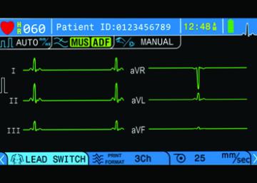 Gnx Color-TFT-Display-1614343271 BPL Cardiart 3-channel ECG Machine GenX3